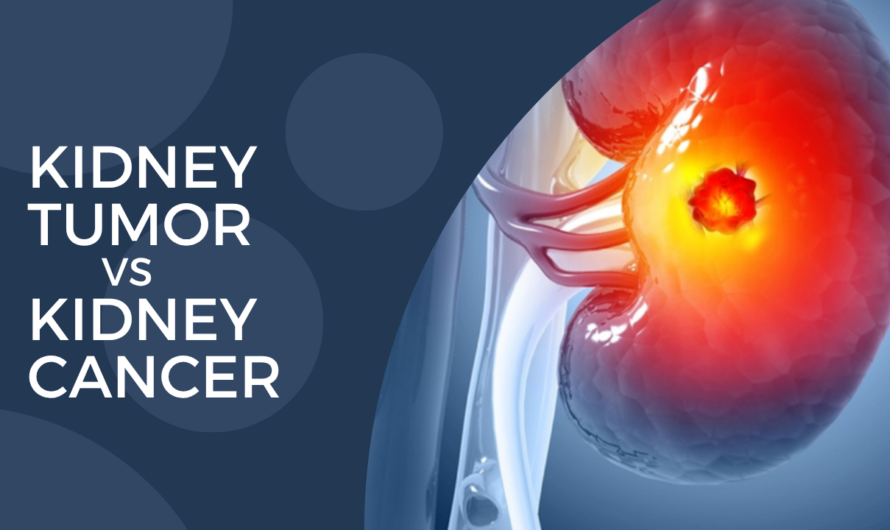 Kidney Tumor vs Kidney Cancer: What’s the Difference?
