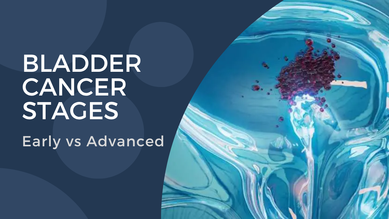Bladder Cancer Stages: Early vs Advanced – What Patients Must Know - Dr ...