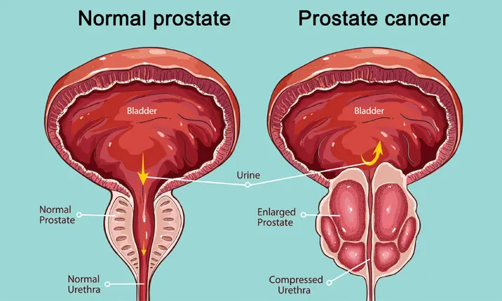 Prostate Cancer Surgery in Mumbai