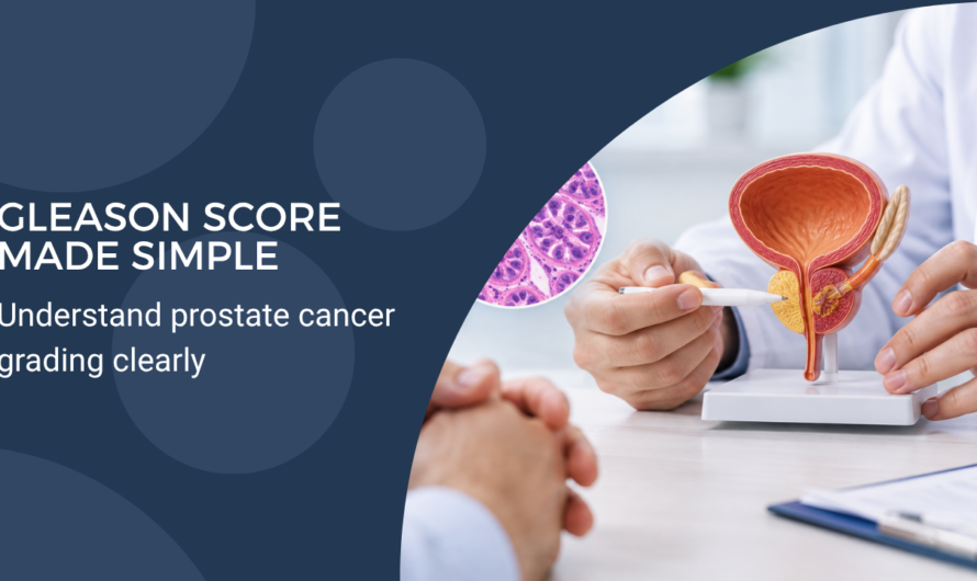 Understanding the Gleason Score: What Your Prostate Cancer Report Means